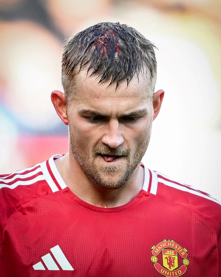 De Ligt Chịu Vết Thương Đẫm Máu Sau Va Chạm Thô Bạo Trong Trận Gặp Brentford