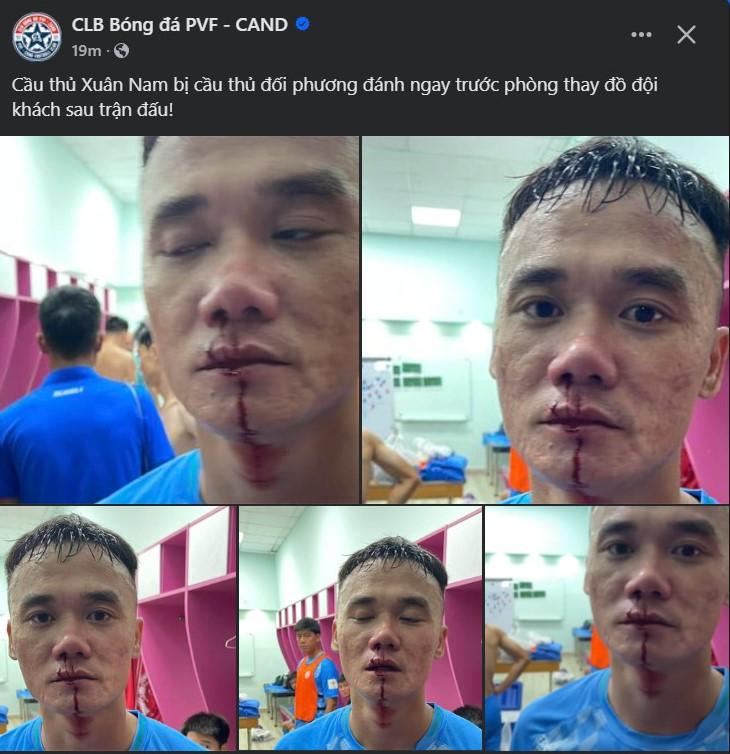 Bạo lực kinh hoàng sau trận đấu hạng Nhất Tiền đạo Nguyễn Xuân Nam bị đấm chảy máu