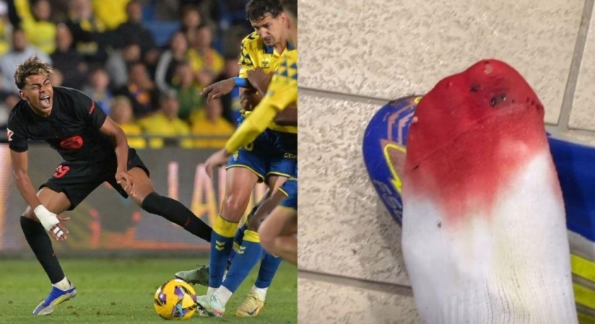 Lamine Yamal: Chấn thương đáng tiếc trước trận bán kết Copa del Rey