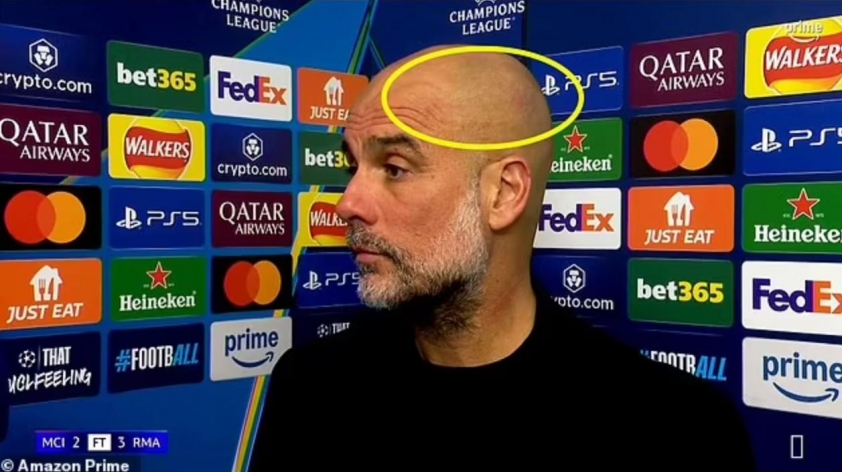 Vết xước trên đầu Pep Guardiola: Áp lực khủng khiếp và tương lai Champions League của Man City