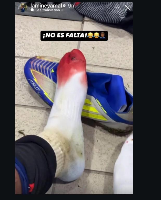 Lamine Yamal: Vết thương đáng lo ngại sau chiến thắng vang dội của Barcelona