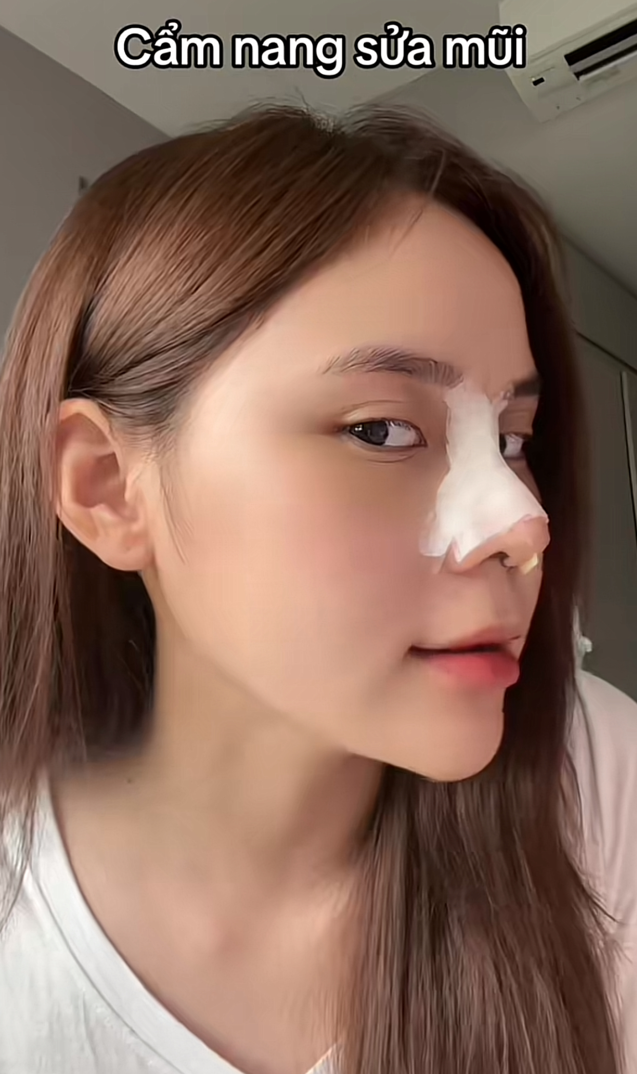 Hậu phẫu thuật thẩm mỹ, bạn thân Trần Hà Linh khiến fan ngỡ ngàng với nhan sắc lạ lẫm Quá trình chỉnh sửa mũi của hot TikToker
