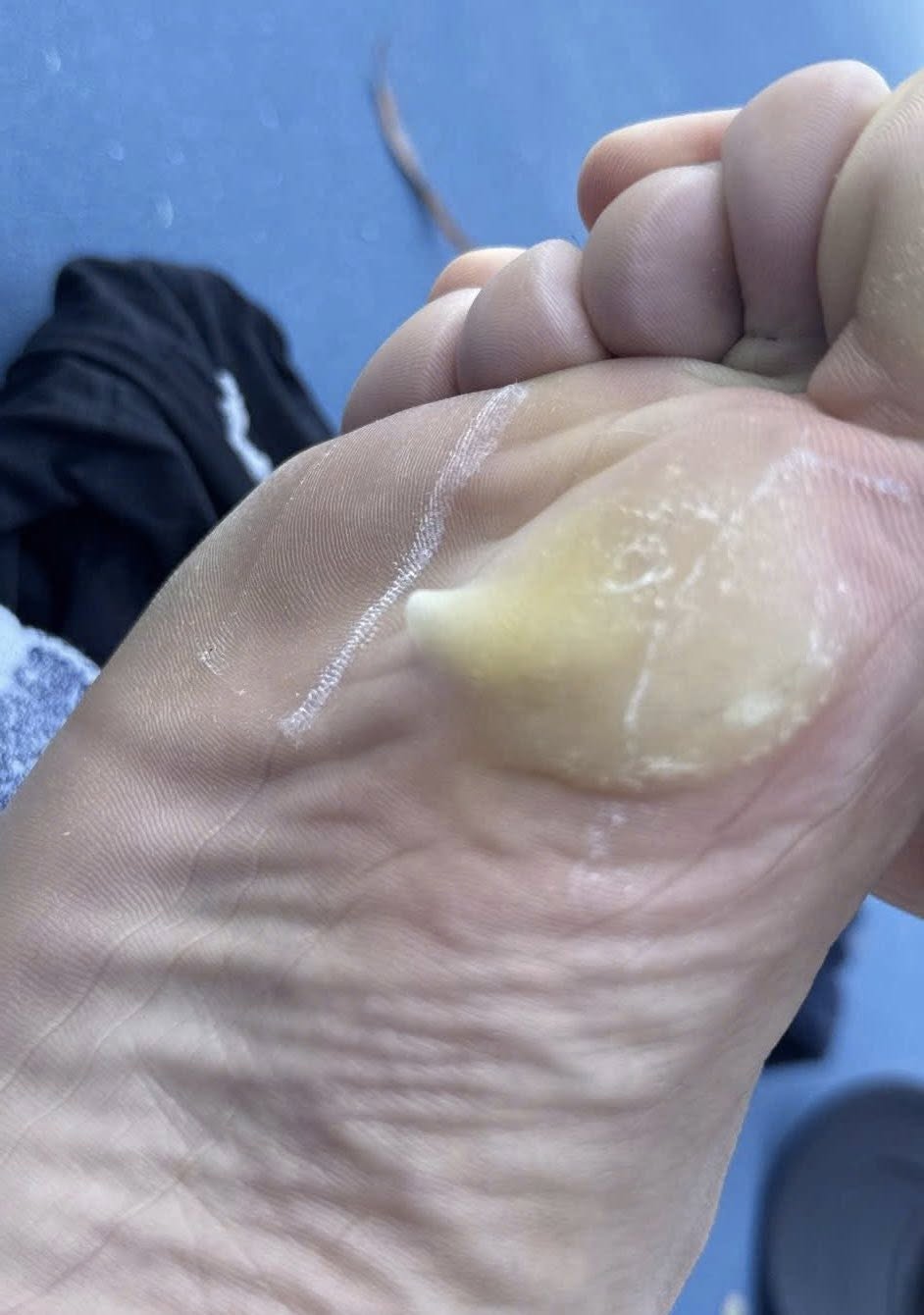 Vận động viên Trương Vinh Hiển bị chấn thương trong thi đấu tại Australia VĐV bị phồng rộp bàn chân sau trận bán kết