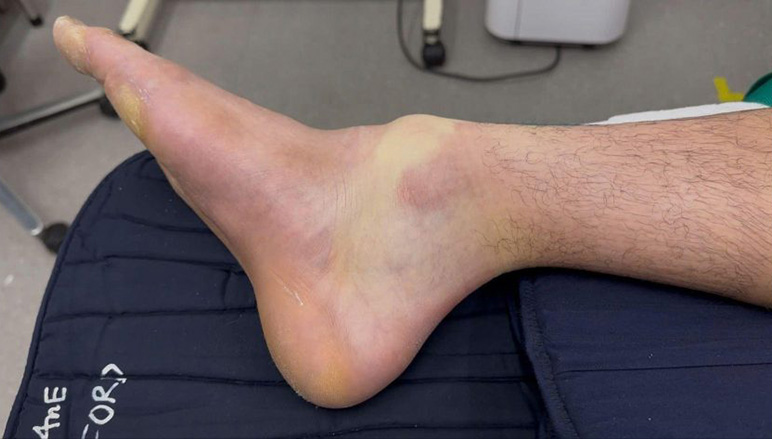 Nam thanh niên bị chấn thương cổ chân nặng sau chơi pickleball