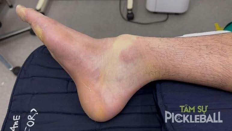 Choáng với hình ảnh cổ chân một thanh niên sau 4 giờ chơi pickleball liên tục - Ảnh 1.