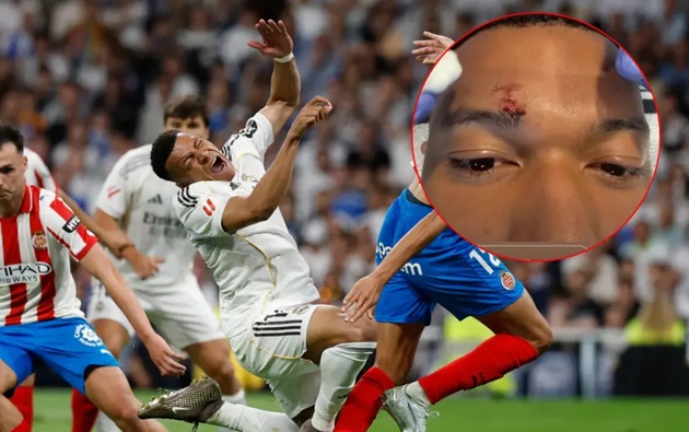 Mbappe vắng mặt do khâu lông mày
